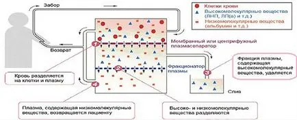 Плазмафереза ​​при псориазис ревюта, цени, нежелани събития