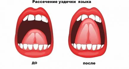 Plastic buzelor și a limbii bride la Celiabinsk prețuri, comentarii și adrese
