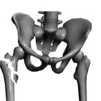 Subtrochanteric törés a combcsont - tünetek és kezelés