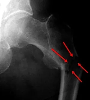 Subtrochanteric Combcsonttörés - Causes, tünetek és kezelés