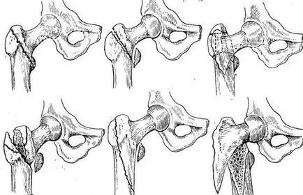 fractură subtrohanteriană a femurului - Simptome si tratament