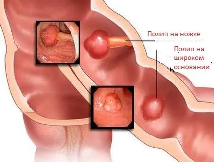 Полипите в симптомите на червата или непълнолетни полипи при дете