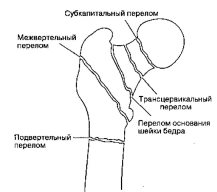 Subtrochanteric счупване на бедрото - причини, симптоми и лечение