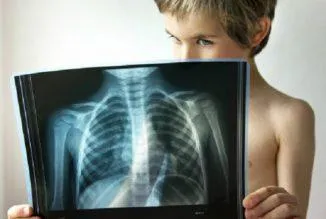 Pneumonia dreapta fata-verso într-un tratat copil rădăcină, focal, polysegmental, lobare