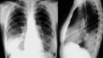 Pneumonia dreapta fata-verso într-un tratat copil rădăcină, focal, polysegmental, lobare