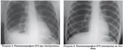 Pneumonia dreapta fata-verso într-un tratat copil rădăcină, focal, polysegmental, lobare