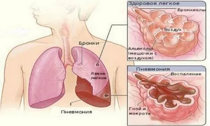 Pneumonia dreapta fata-verso într-un tratat copil rădăcină, focal, polysegmental, lobare