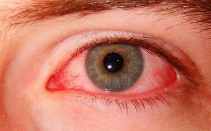 Причината за бялото на очите Reds лекува детето какво да прави, и набраздено от жълто