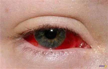 Причината за бялото на очите Reds лекува детето какво да прави, и набраздено от жълто