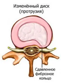 Стърчащи на гръбнака в гръдния диска