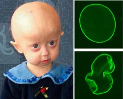 Progeria - idő előtti öregedés szindróma