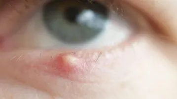 Tünetek az árpa a szem tünetek és a kezelés, amint az a kezdeti szakaszban