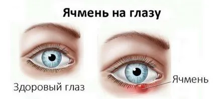 Tünetek az árpa a szem tünetek és a kezelés, amint az a kezdeti szakaszban