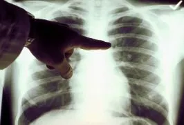 Cancerul pulmonar tablou clinic
