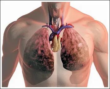 Tüdőrák klinikai kép