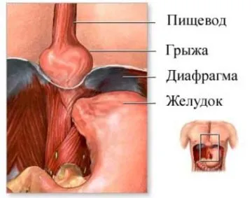 Cinci simptome principale de hernie diafragmatica esofagian