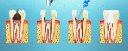 A különbség a fogbél és a fogágy, dentera