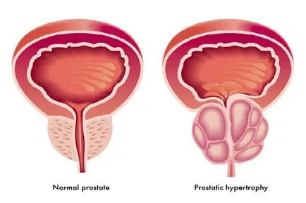 Dimensiunile prostatei este normal la calculul indicatorilor cu ultrasunete liniare, calculul volumului și masei