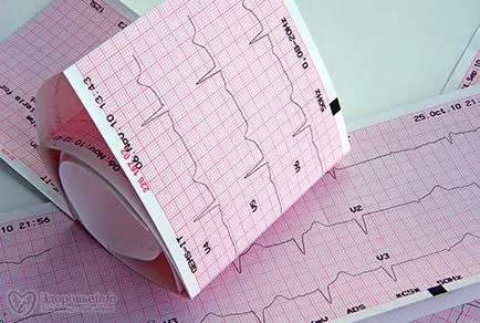 Semnele precoce de infarct miocardic - tratament de inima