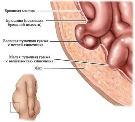 Hernia ombilicala la barbati cauze, simptome, tratament, diagnostic, chirurgie