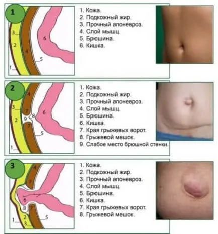 A köldöksérv férfiaknál okoz, tünetek, kezelés, diagnosztikai, sebészi