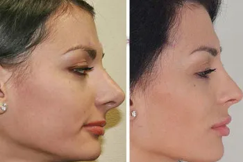 Rinoplastia - reabilitarea și reconstrucția, consecințele