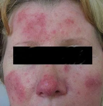 Rosacea tünetek, okok, kezelés