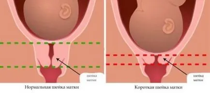 Colul uterin în timpul sarcinii, ca modificarile in timpul sarcinii