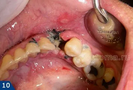 Cum se vindeca gingiile după îndepărtarea - cum de a accelera vindecarea rănilor