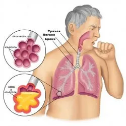 Стрептококи пневмония - скалпел - медицинска информация и образователен портал