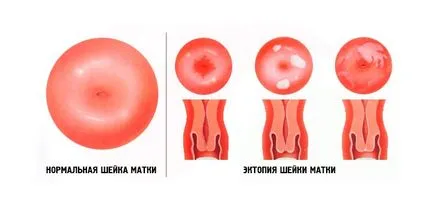 tratare și eliminare opțiuni ectopice cervicale endocervicosis pseudo