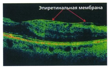 Epiretinális membrán a szem - tünetek és kezelést, mint egy művelet történik