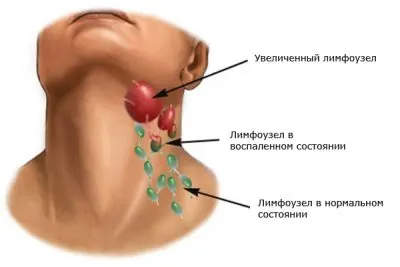 мозъчните токсоплазмоза симптоми, последствия