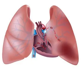 Белодробна емболия подходи за диагностика и лечение през 2015 г., предаде електронното издание - новини