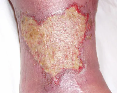 ulcer trofice asupra cauzelor picior și unguentele etapă de tratament, antibiotice