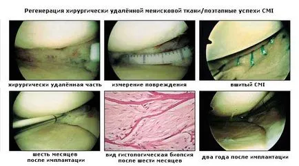 meniscus transzplantáció