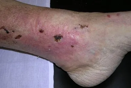 ulcer trofice asupra cauzelor picior și unguentele etapă de tratament, antibiotice