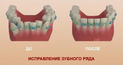 Szerelése modern fogszabályozó a Bobruisk