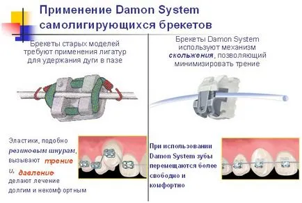 Монтаж на съвременни скоби в Бобруйск