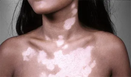Vitiligo okozza a megjelenését kor foltok és a kezelés