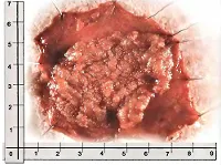 Villosus adenoma a vastagbél - okai, tünetei, diagnózisa és kezelése