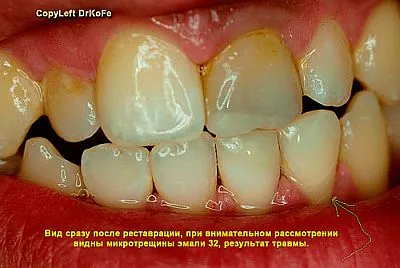 Întrebări și răspunsuri după restaurarea dinților