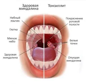 amigdalită cronică tratate la domiciliu rapid