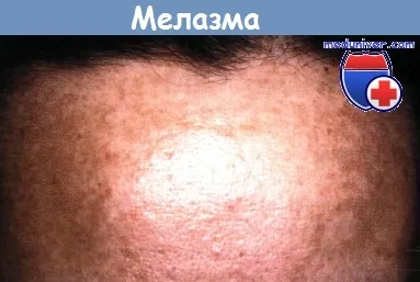 Chloasma (melasma) - tünetei, diagnózis és kezelés