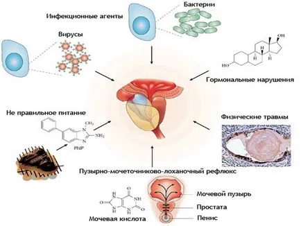 Хроничен простатит могат да бъдат излекувани симптомите и лечения