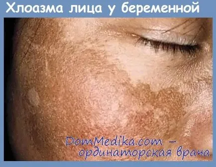 Chloasma (melasma) - tünetei, diagnózis és kezelés