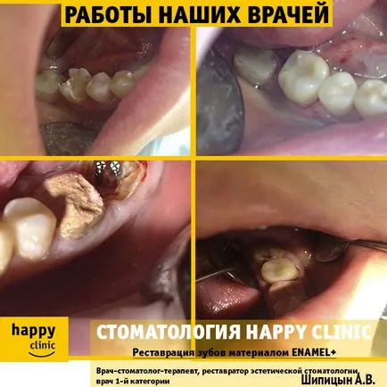 Описание В, естетически възстановяването на зъби материал композитен емайл плюс