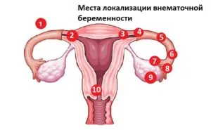 Zamershego méhen kívüli terhesség jellemzői és okai, kezelése
