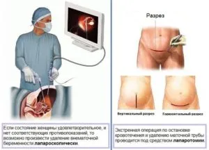 Zamershego извънматочна бременност функции и каузи, пречиствателни