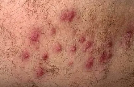 Folliculitis слабините опитен дерматолог в Москва